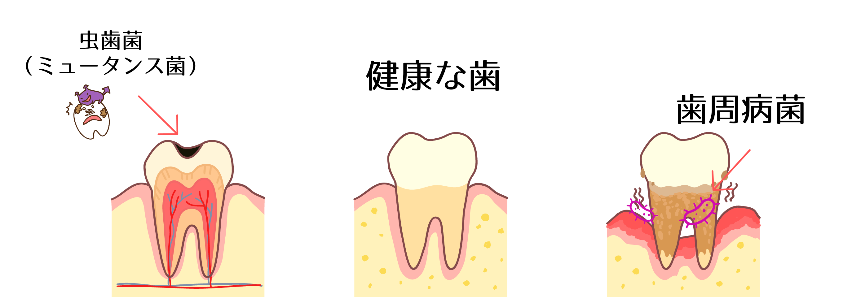 虫歯と歯周病　二宮町　はら歯科クリニック